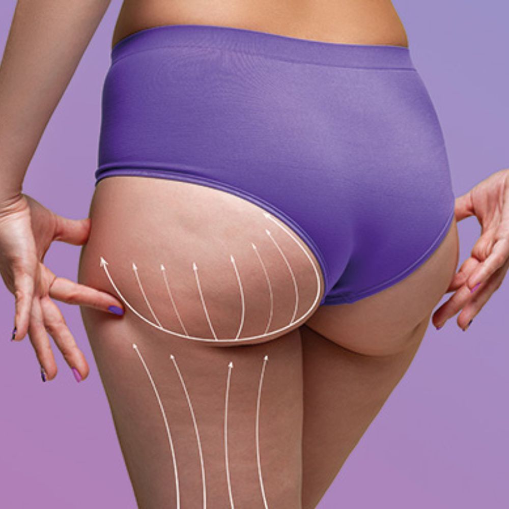 Gaines pour Éviter la Chirurgie : Brazilian Butt Lift (BBL)